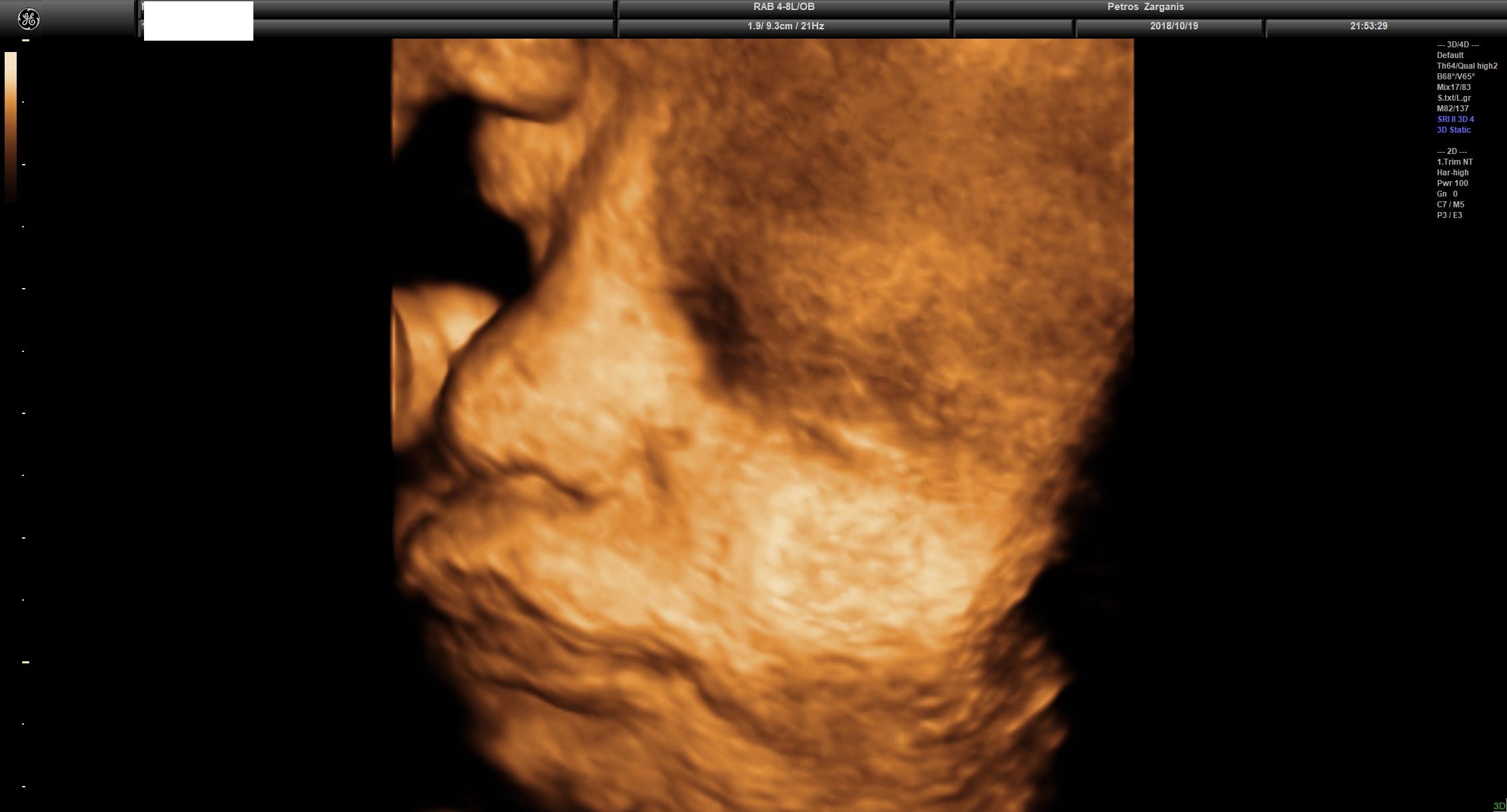 Εμβρυο 36 Εβδομάδων Προγεννητική Υπερηχογραφία 3D 14